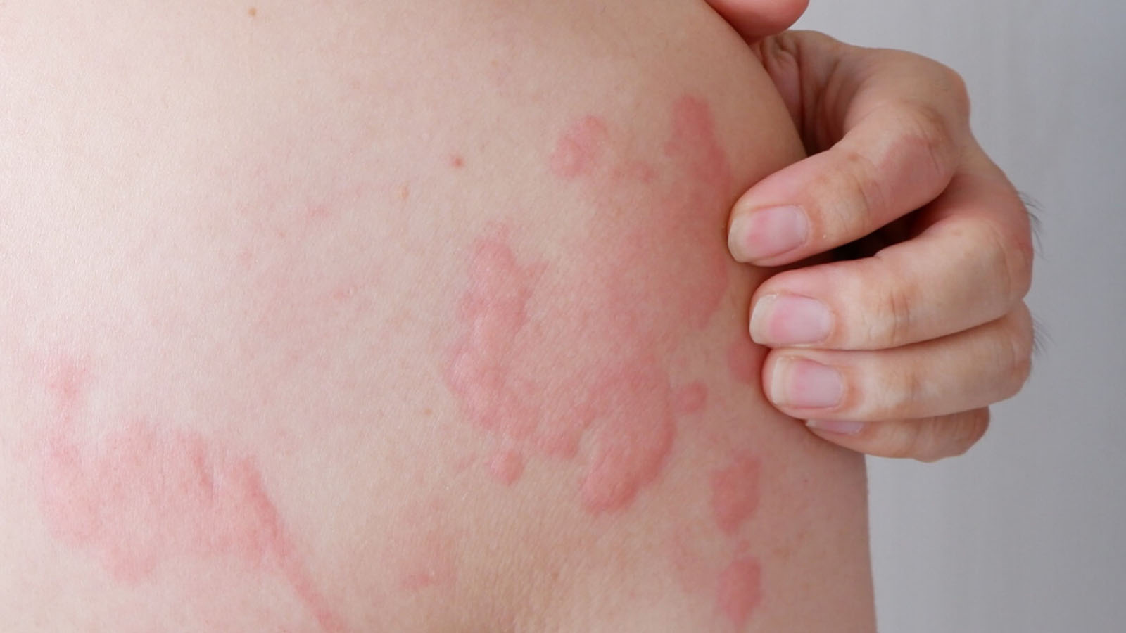 خطرناک ترین بیماری پوستی