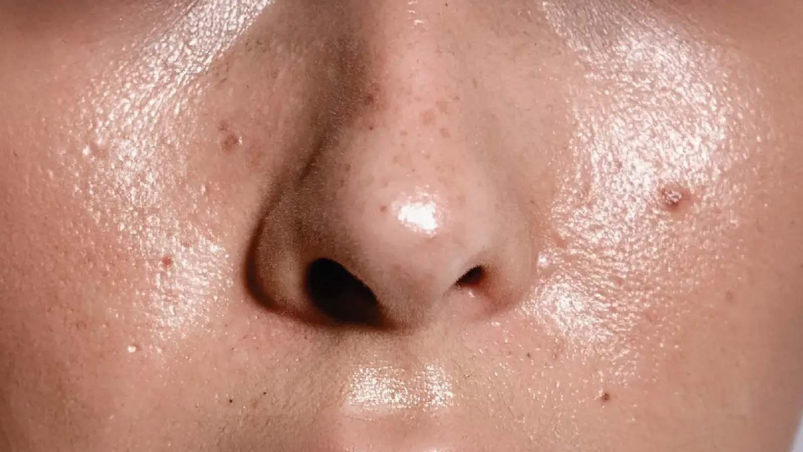 تست تشخیص نوع پوست