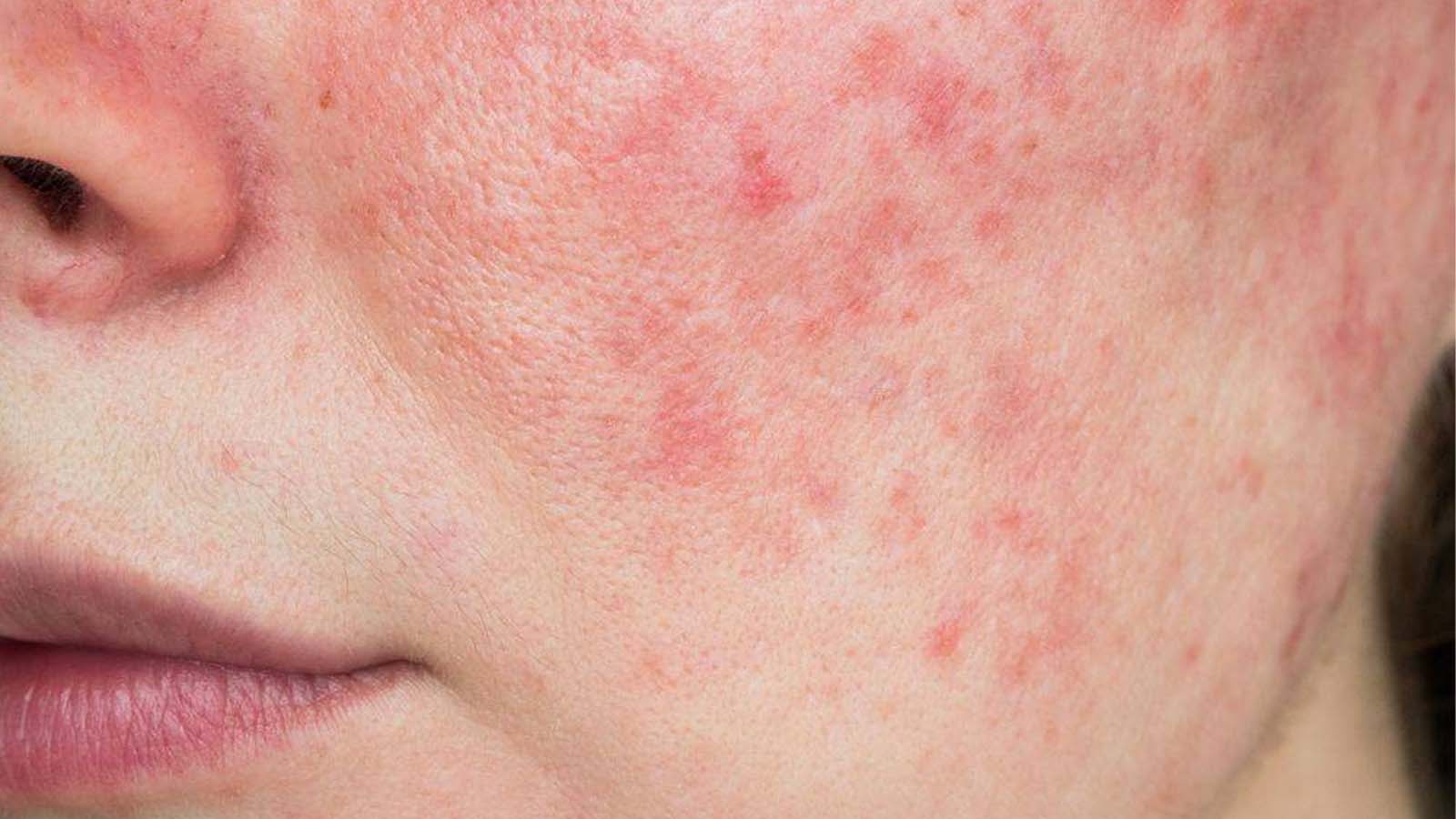 عکس انواع پوست ها