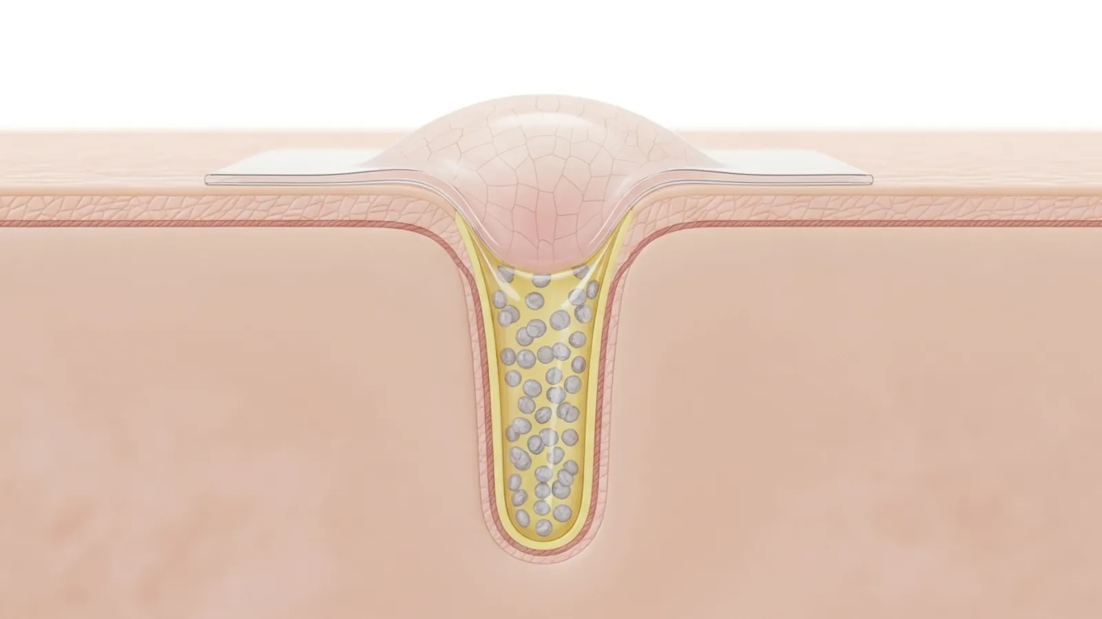 جوش سر سفید