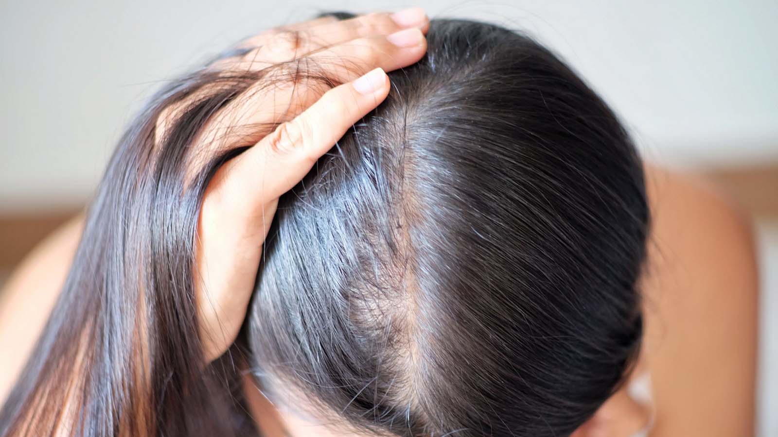 کمبود آهن و ریزش مو