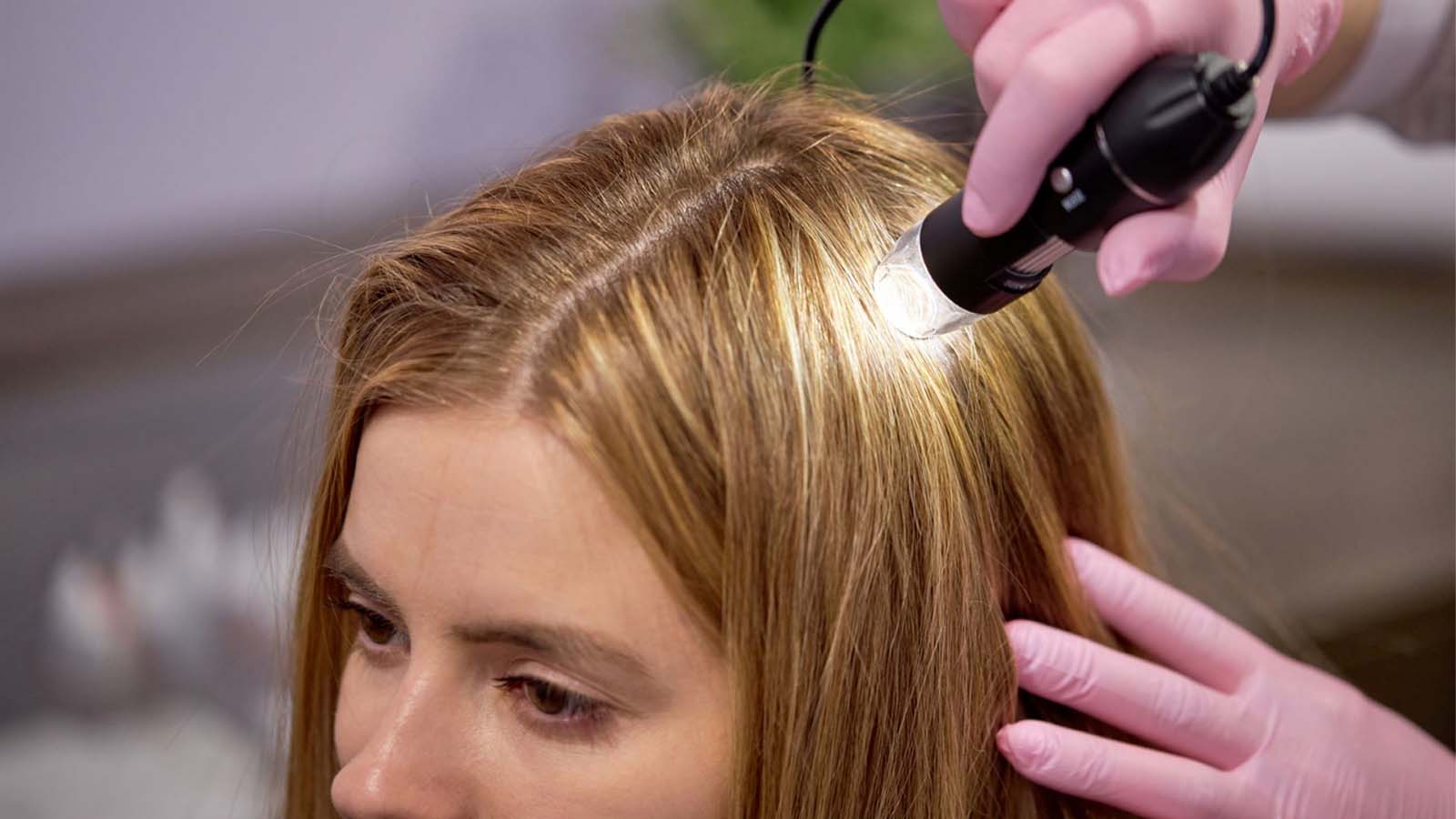 ماینوکسیدیل برای درمان ریزش مو زنان