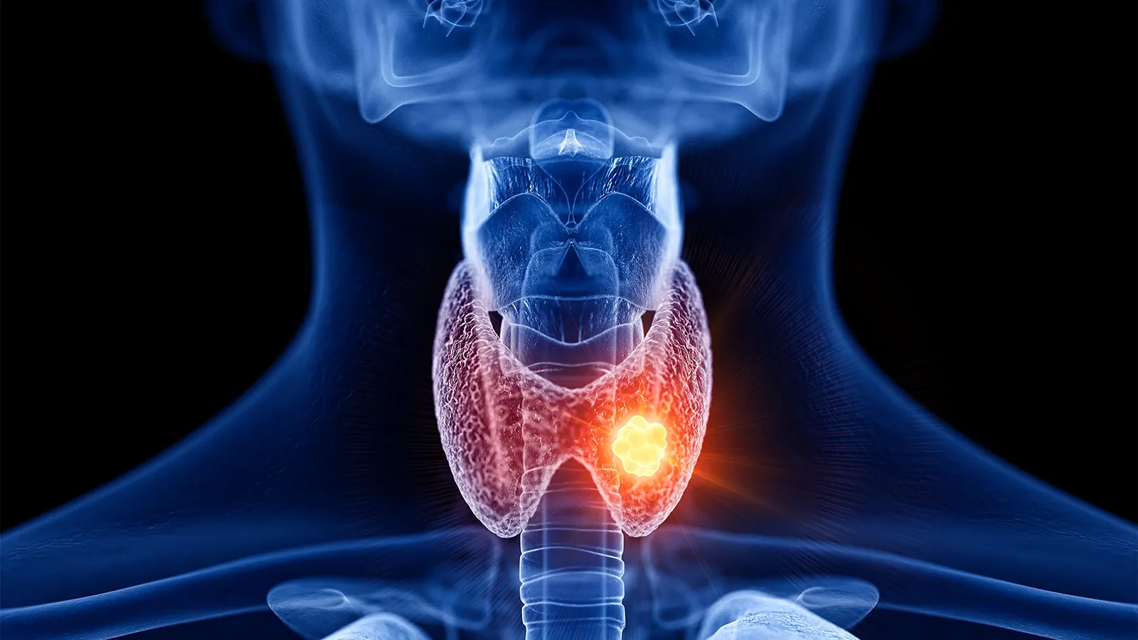 درمان تیروئید