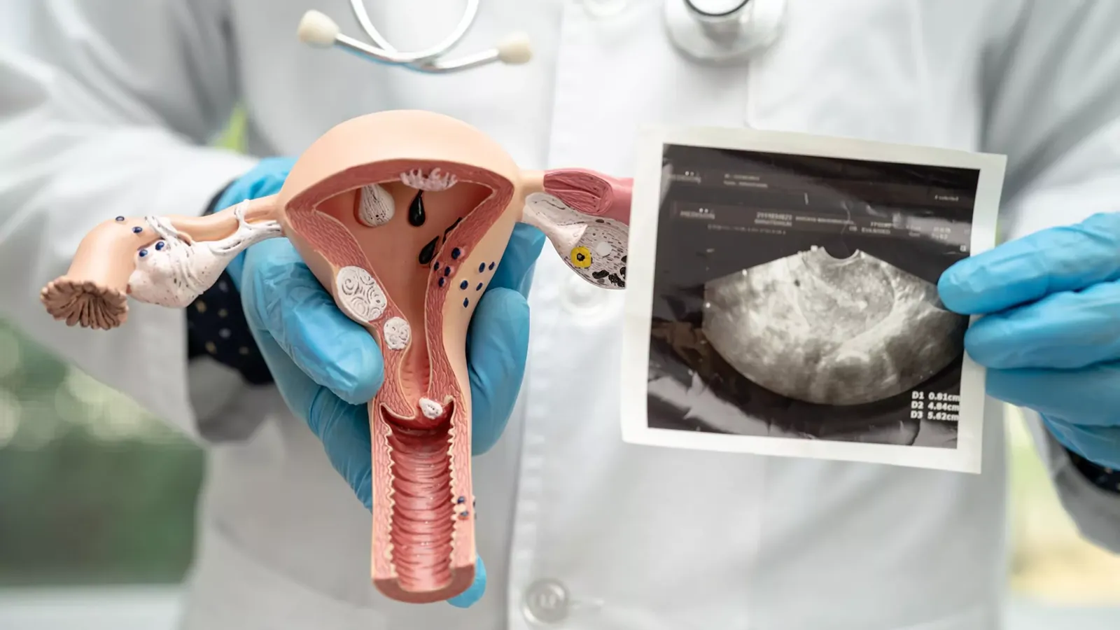 آیا سندرم تخمدان پلی کیستیک درمان دارد