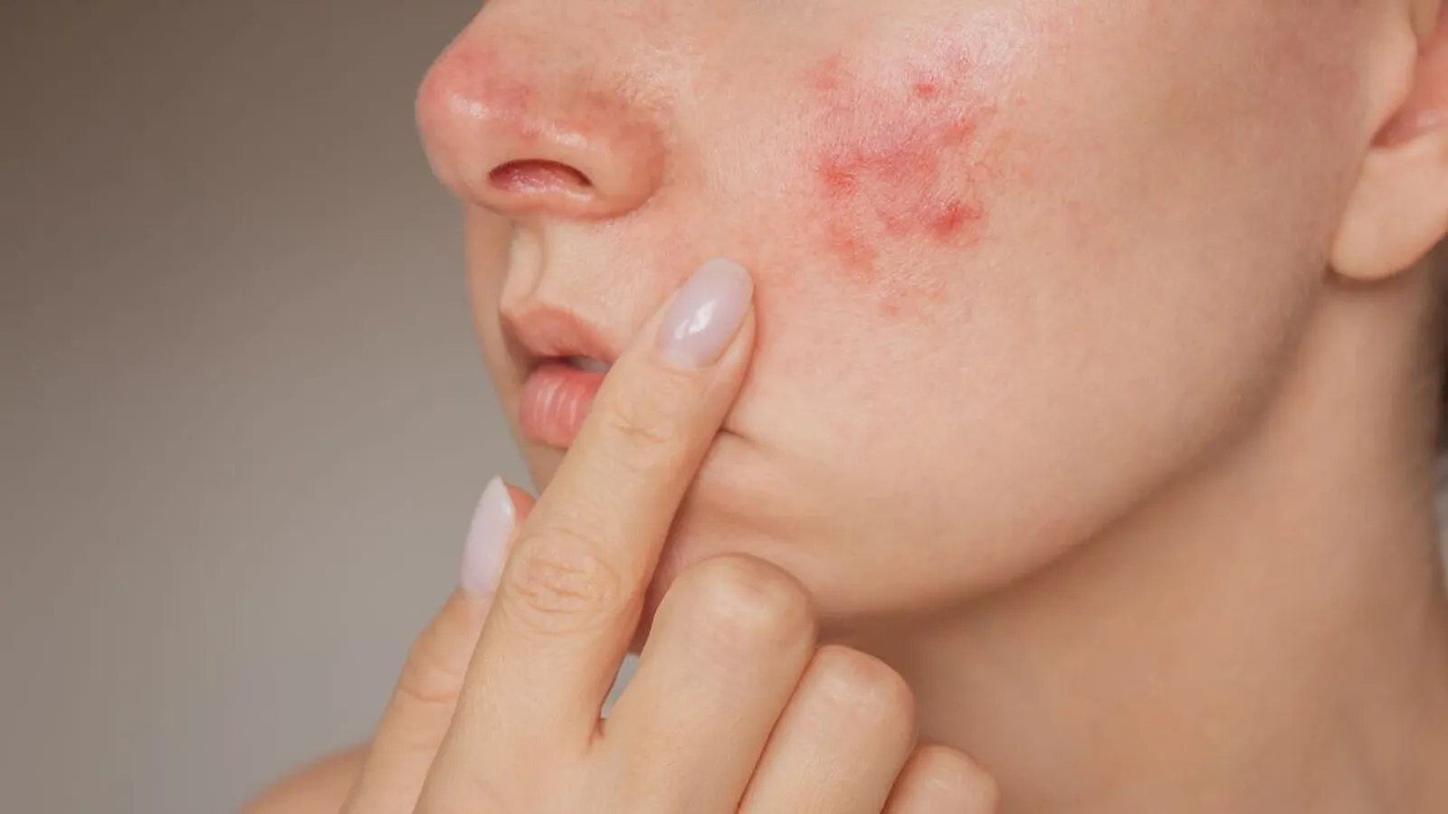 چند روز قبل از قاعدگی جوش میزنیم