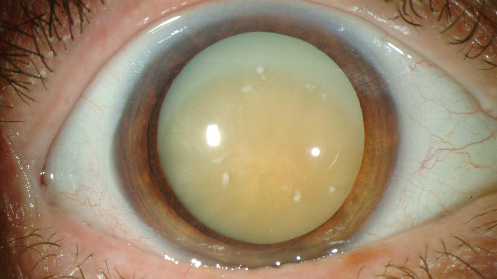 عمل آب مروارید چشم چقدر طول میکشد