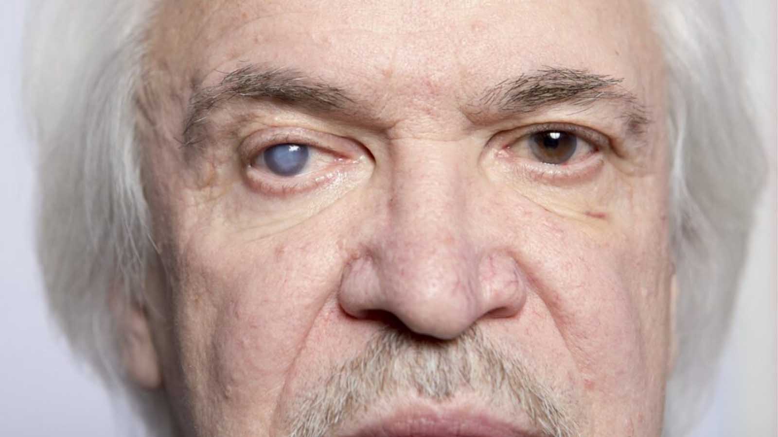 درمان اب مروارید خفیف