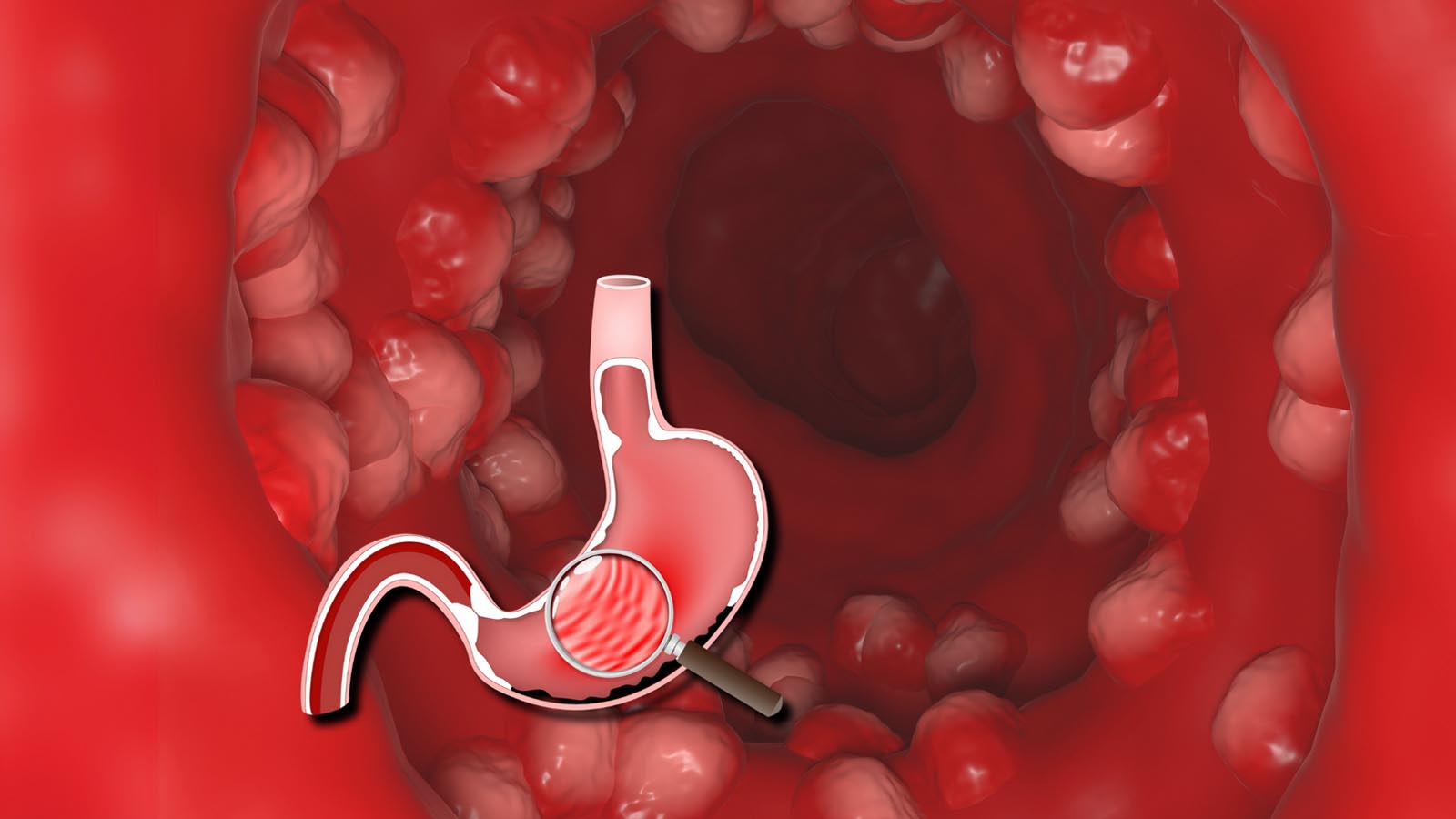 گاستریت معده