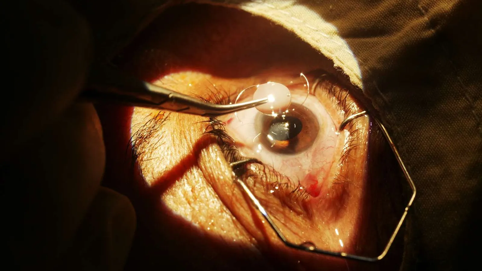 عمل آب مروارید