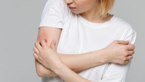 واکنش آلرژیک