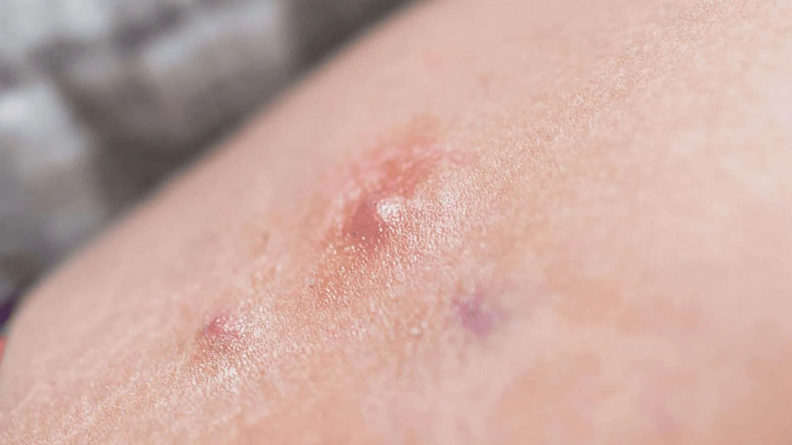 بیماری هیدرآدنیت چرکی