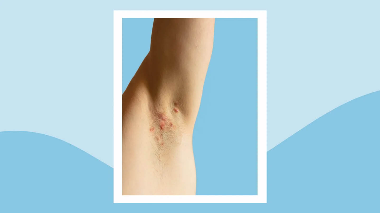 هیدرآدنیت چرکی تناسلی