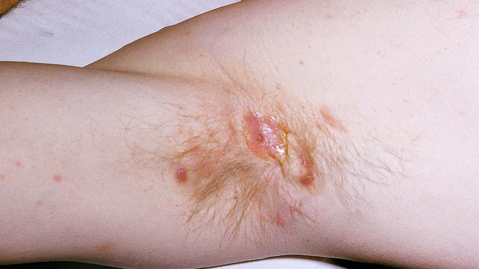 هیدرآدنیت چرکی درمان