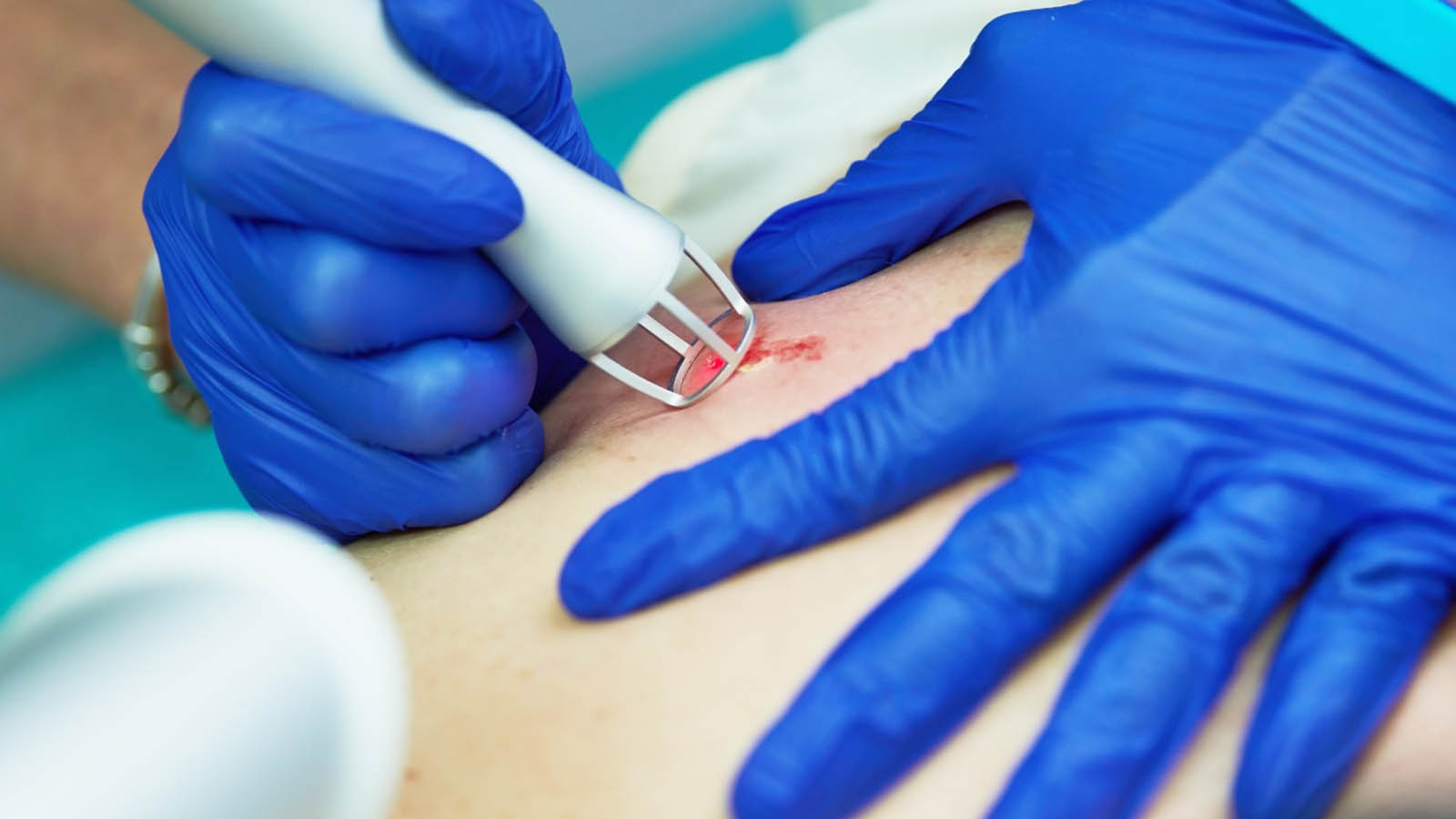 هیدرآدنیت چرکی کشاله ران