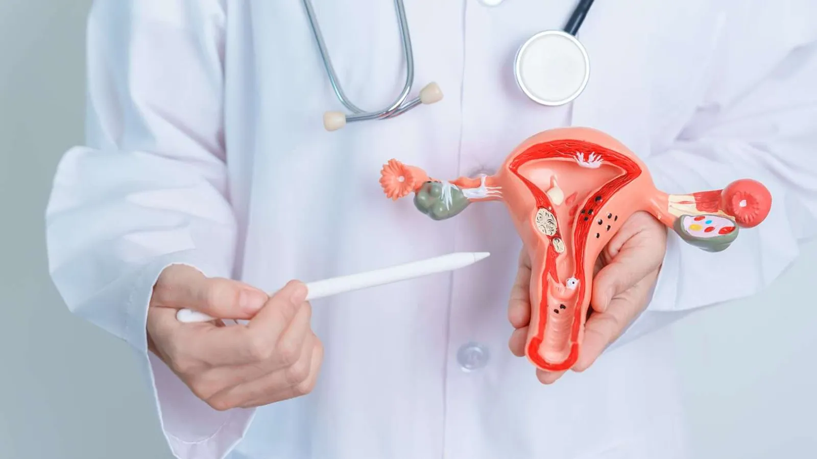 علت ابتلا به سندرم تخمدان پلی کیستیک یا PCOS