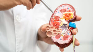 سنگ کلیه چیست؟ علائم، علل و راه‌های درمان و دفع