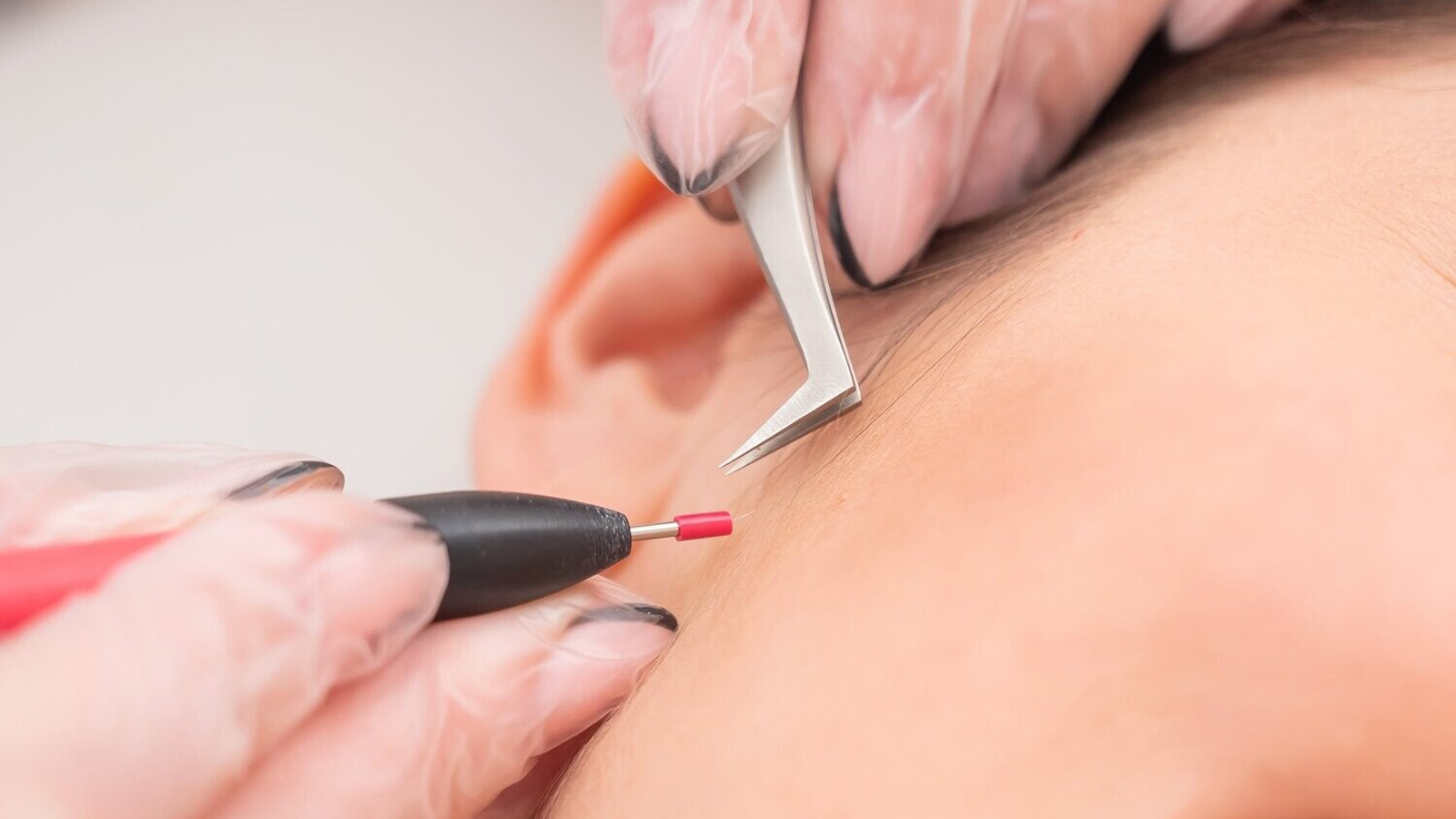 دستگاه الکترولیز موهای زائد