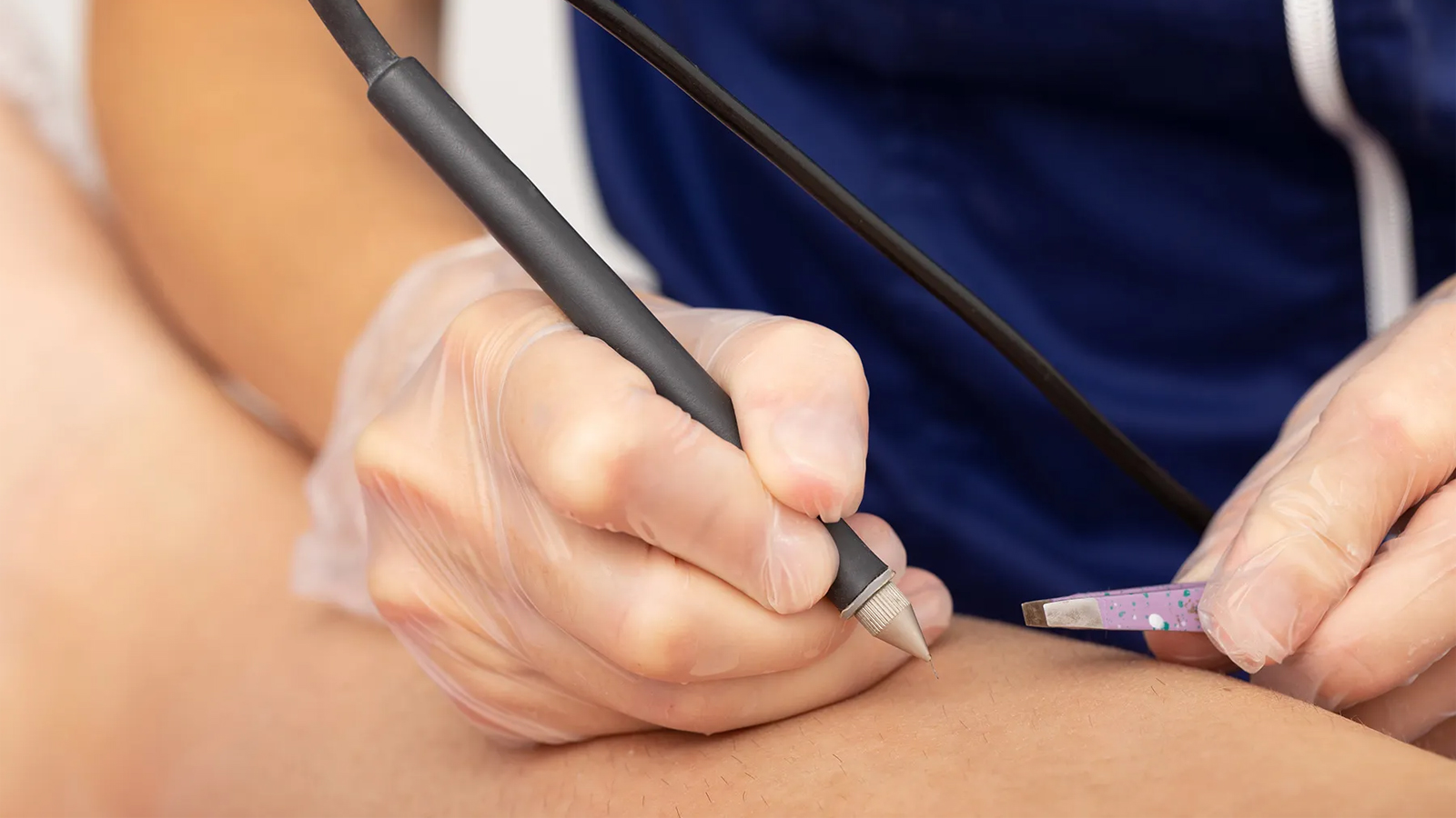 الکترولیز موهای زائد بیکینی