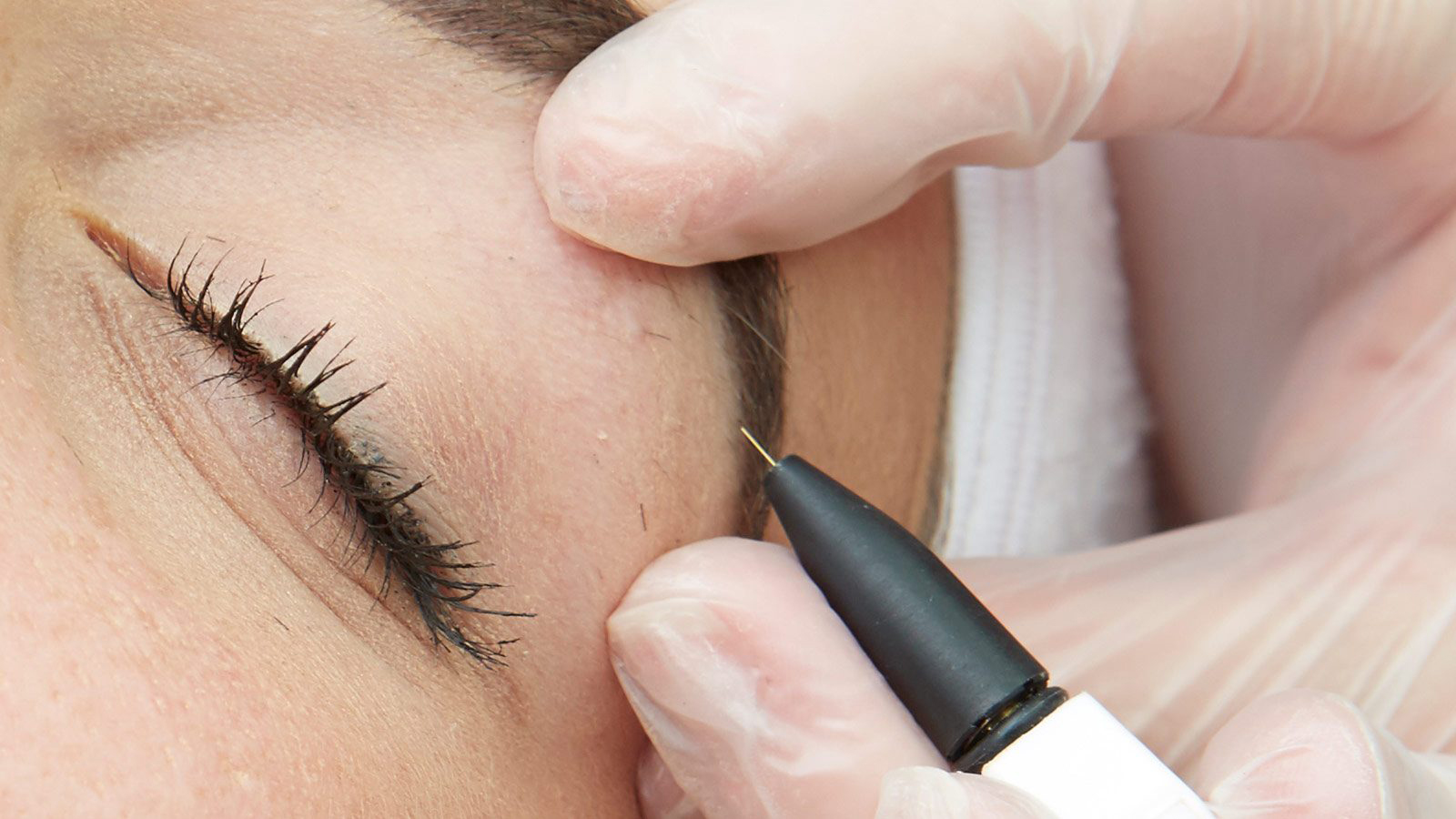 هزینه الکترولیز موهای زائد