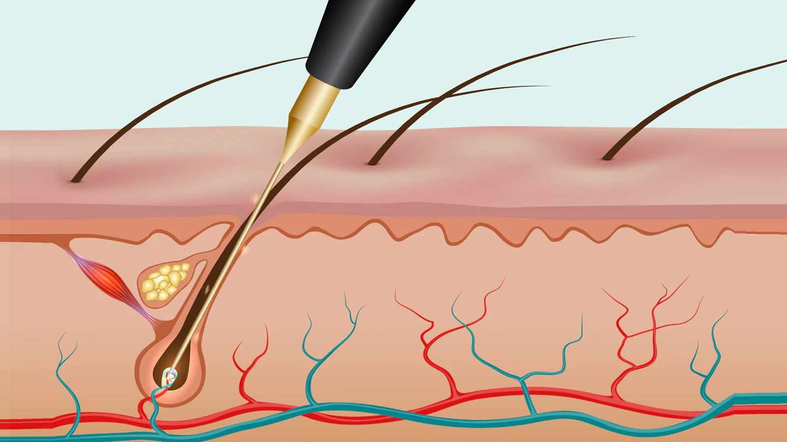 الکترولیز موهای زائد چیست؟