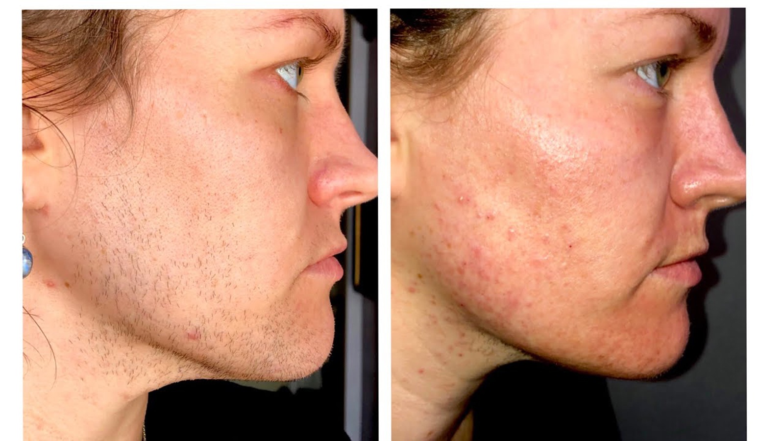 الکترولیز موهای زائد در تهران