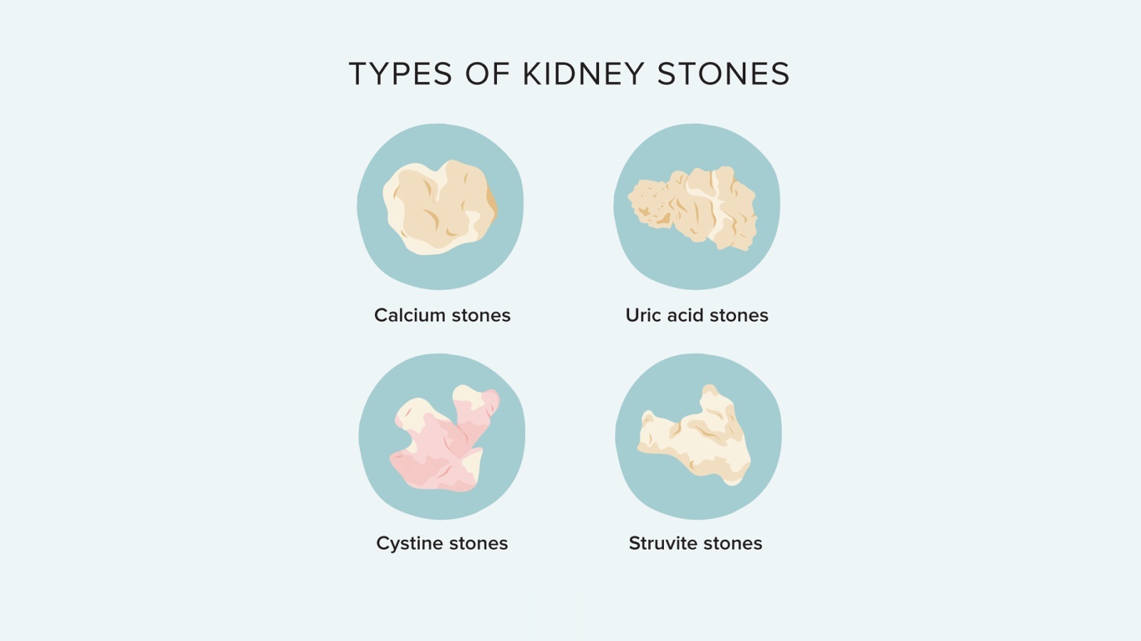 انواع سنگ کلیه