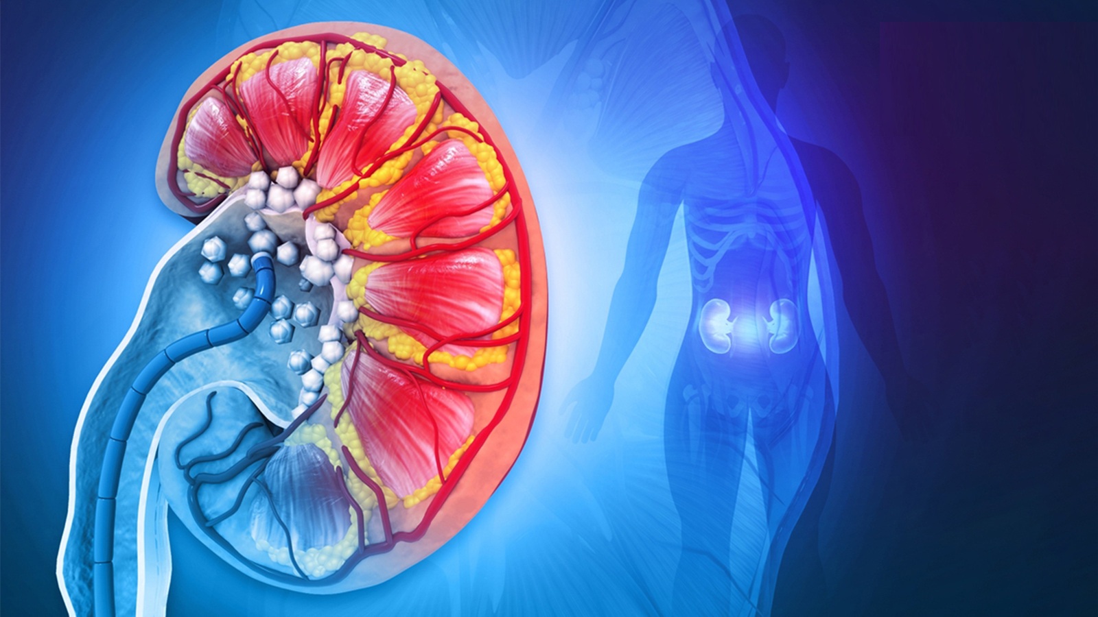 درمان سنگ کلیه