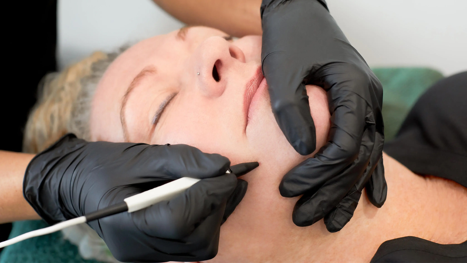 عوارض الکترولیز موهای زائد