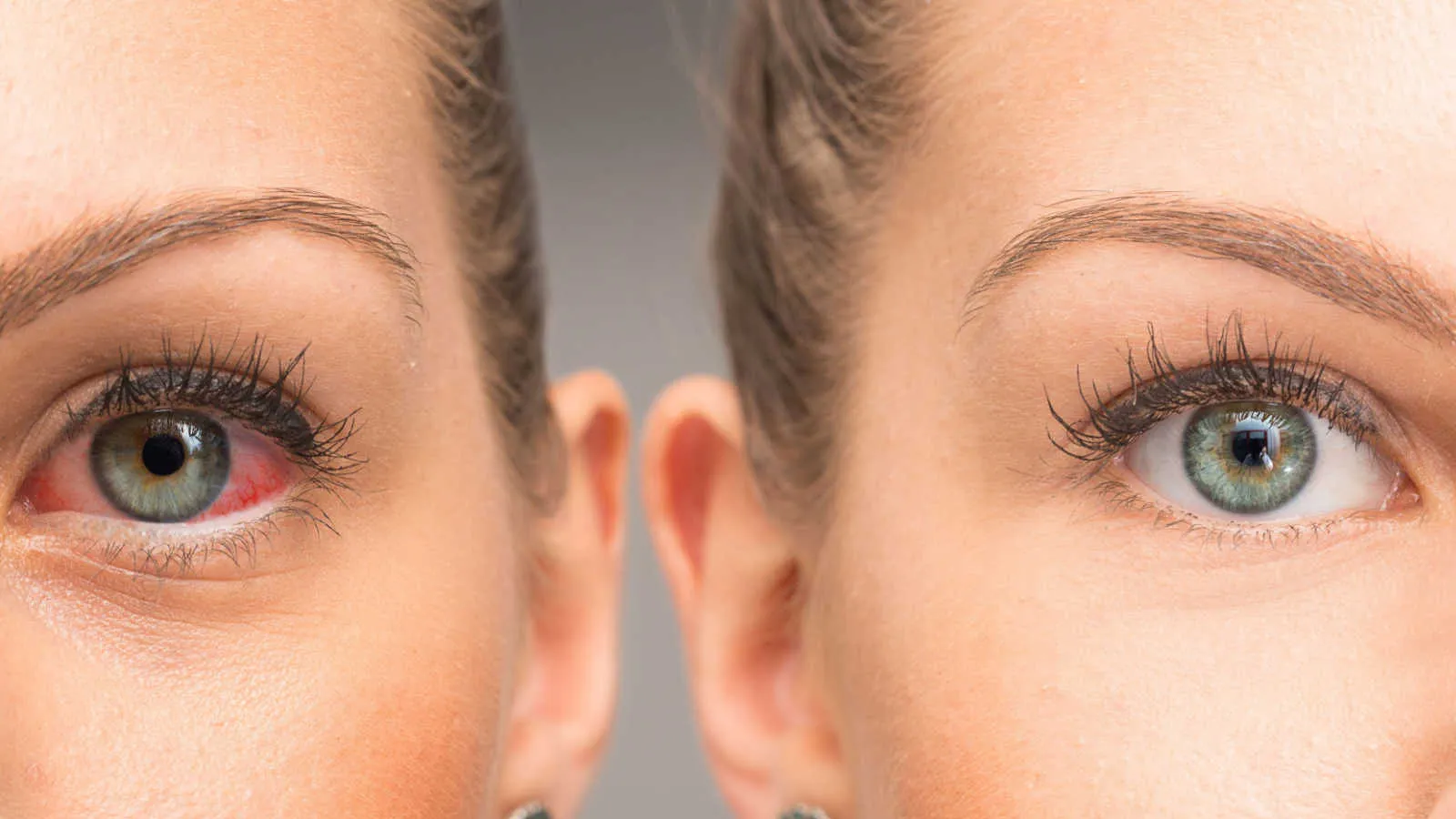 گلوکوم چشمی