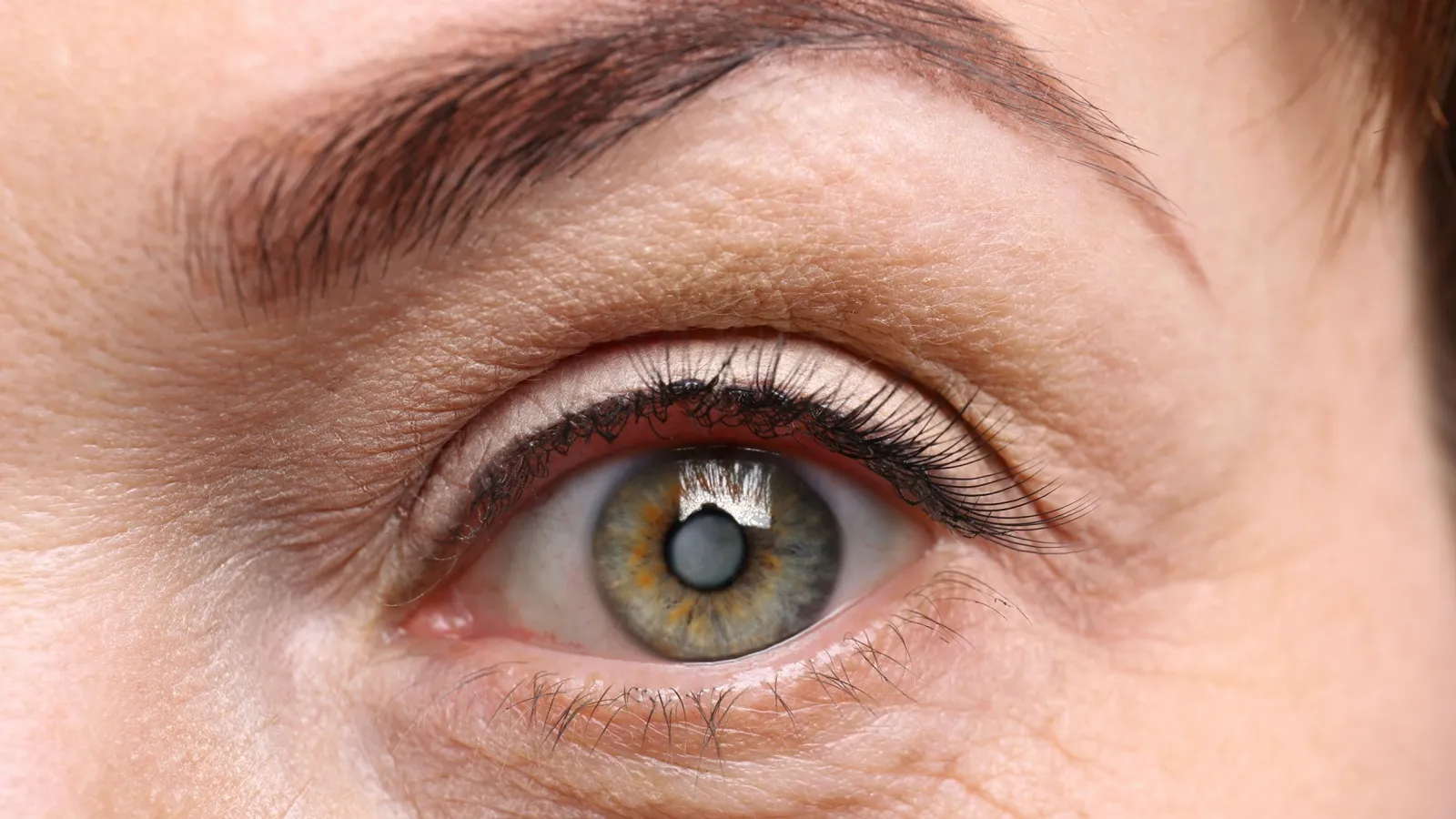 علت آب مروارید چشم