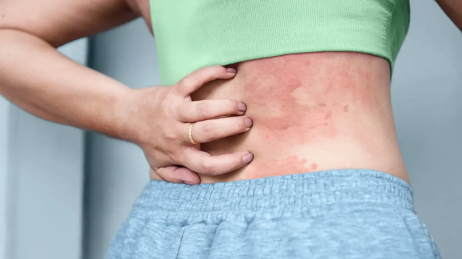 عکس کهیر عصبی