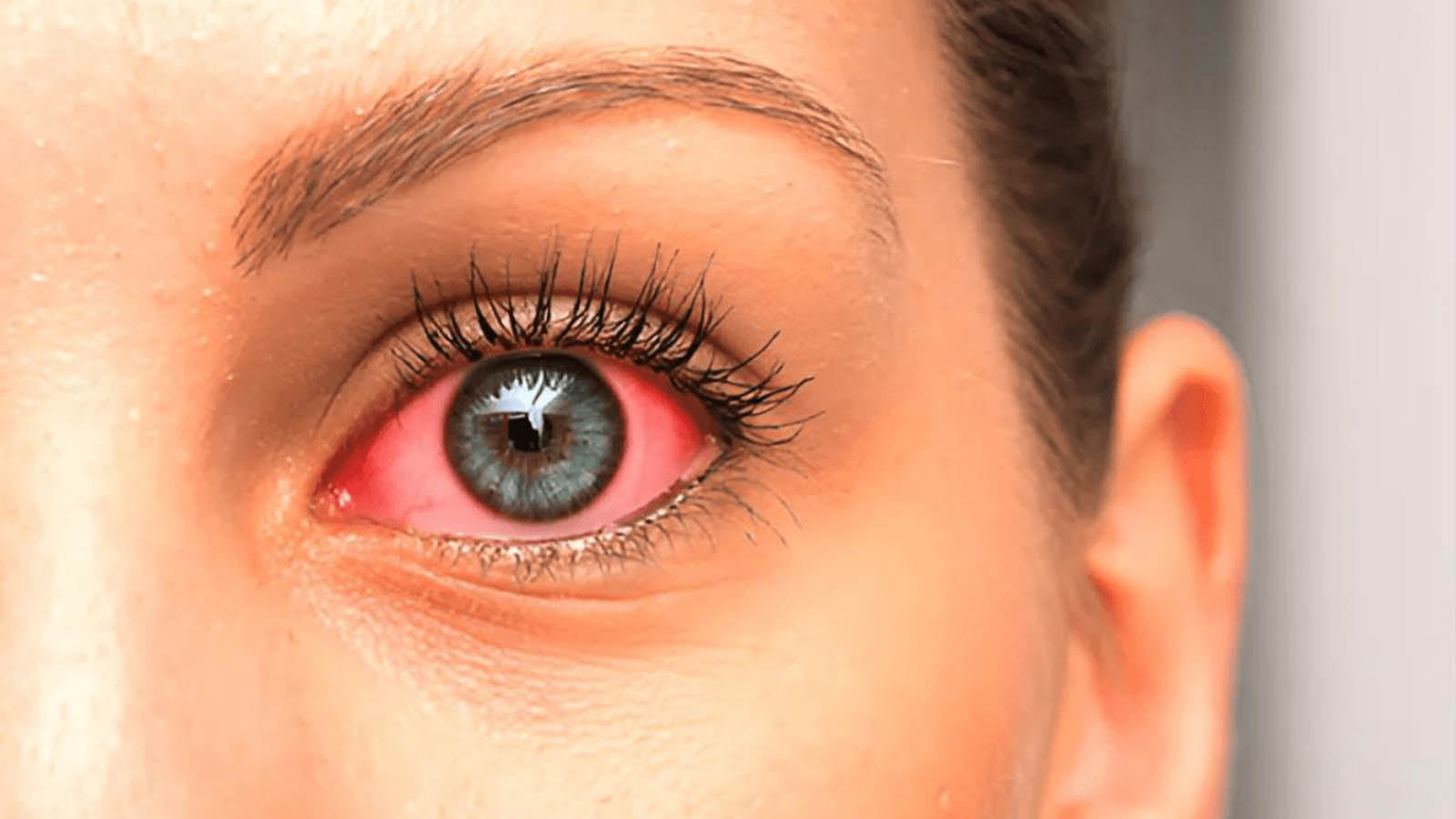 جراحی گلوکوم