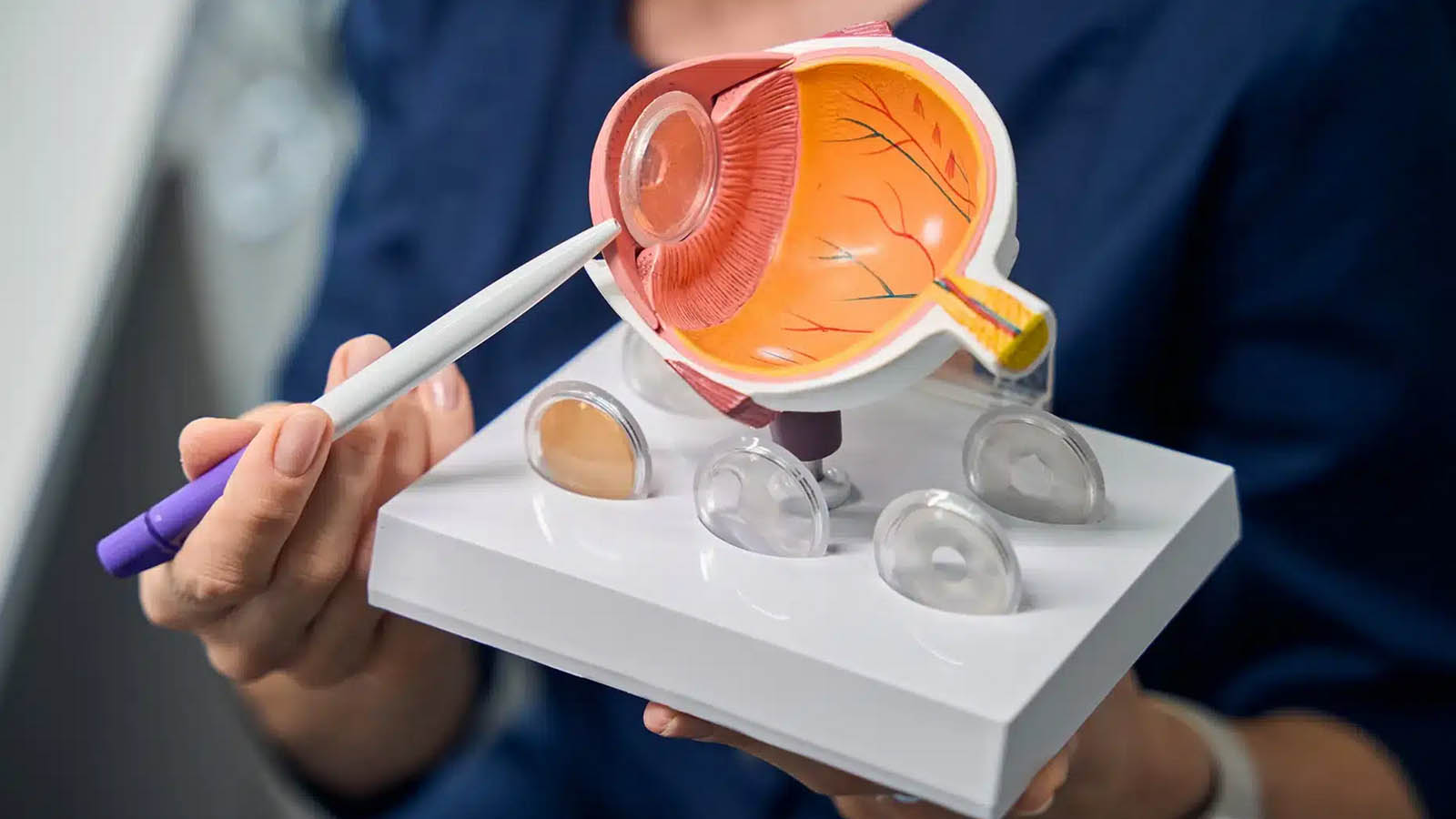 علائم گلوکوم زاویه باز