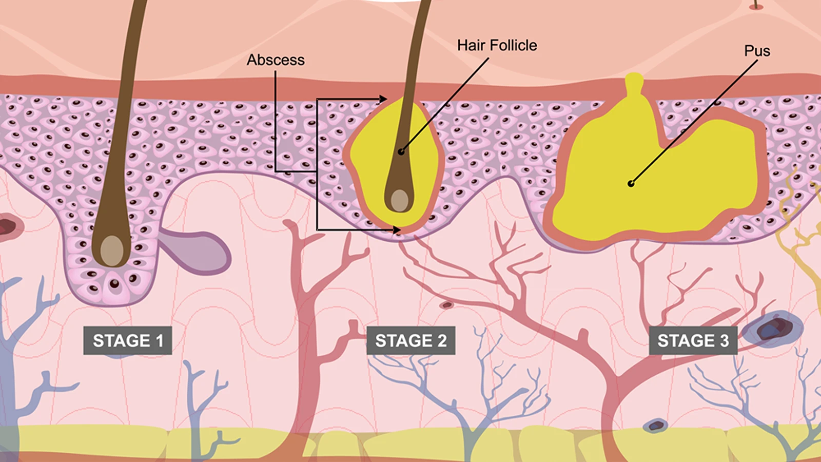 هیدرادنیت چرکی