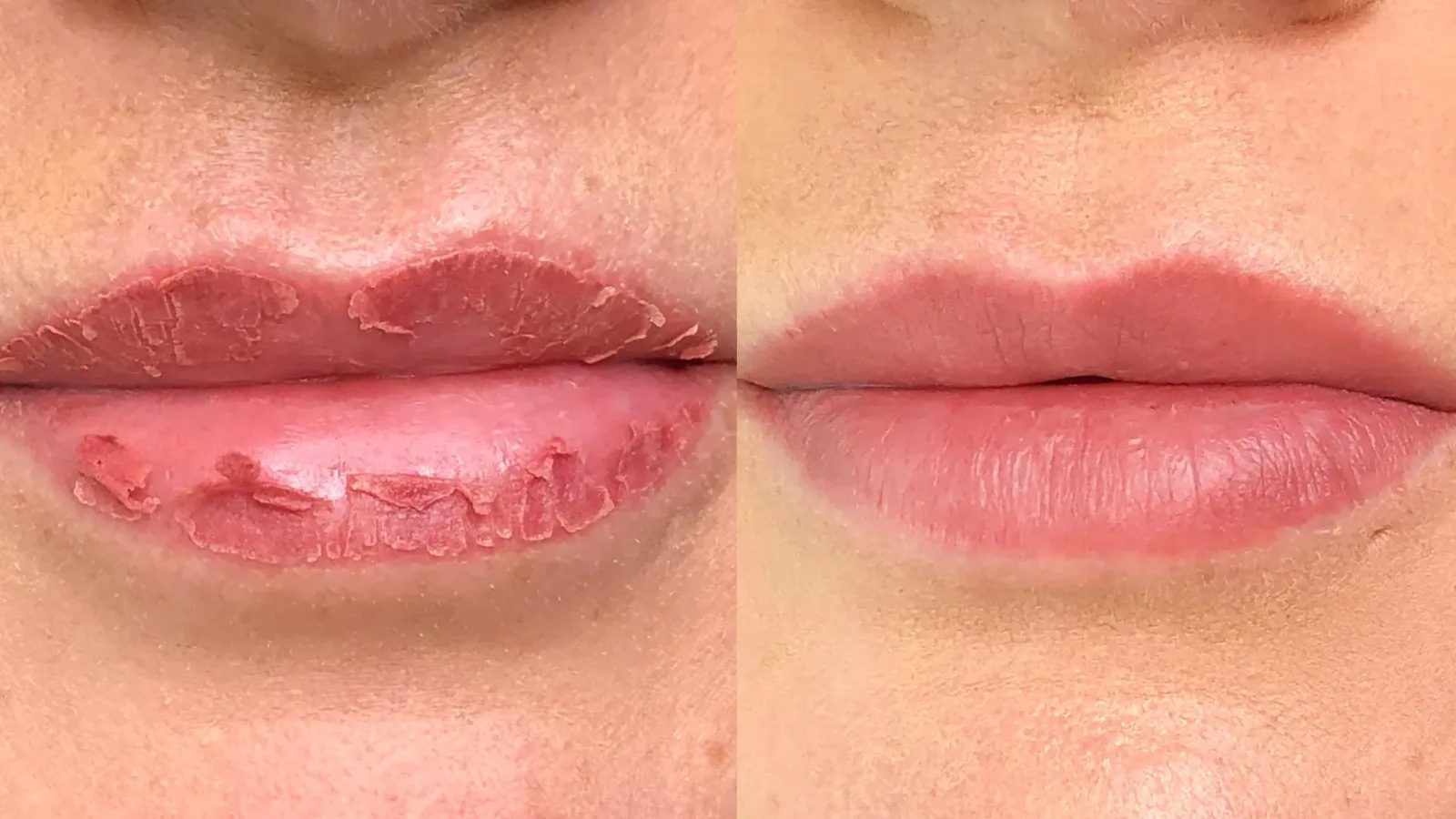 پوسته‌ریزی