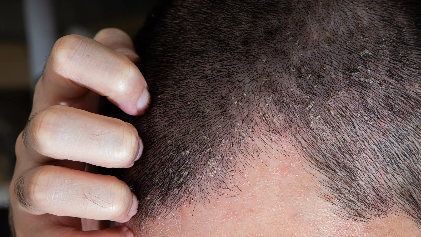 درماتیت تماسی و تحریک پوست