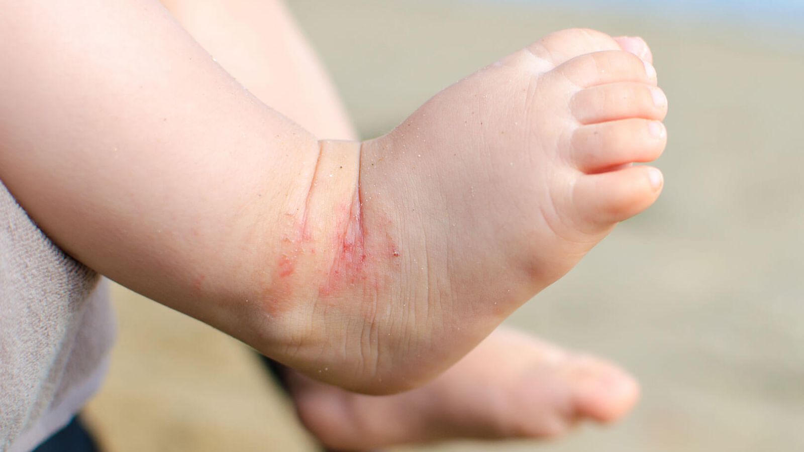 آلرژی غذایی در نوزادان 