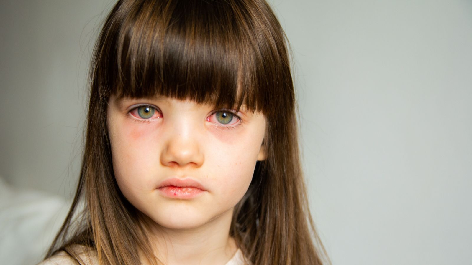 کونژنکتیویت