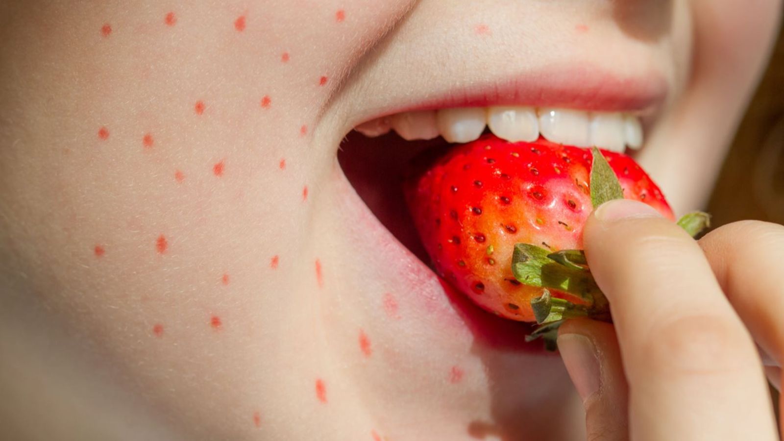 آلرژی غذایی در بزرگسالان