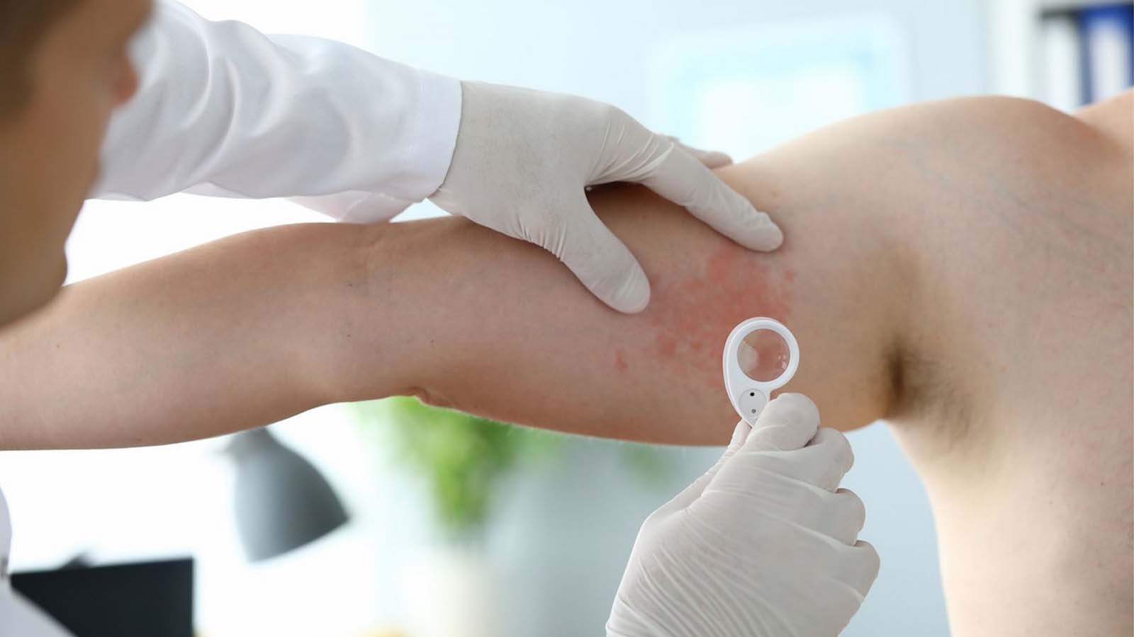 علت کهیر زدن در شب چیست