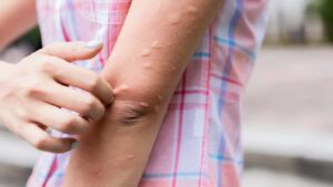 برای درمان کهیر چه بخوریم