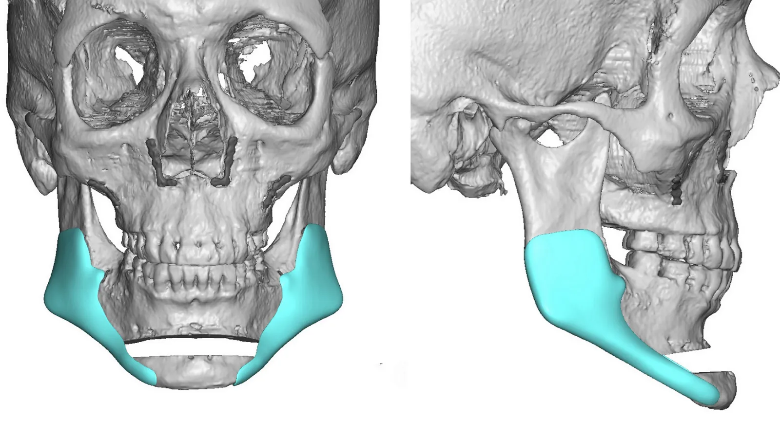 جراحی چانه ژنیوپلاستی