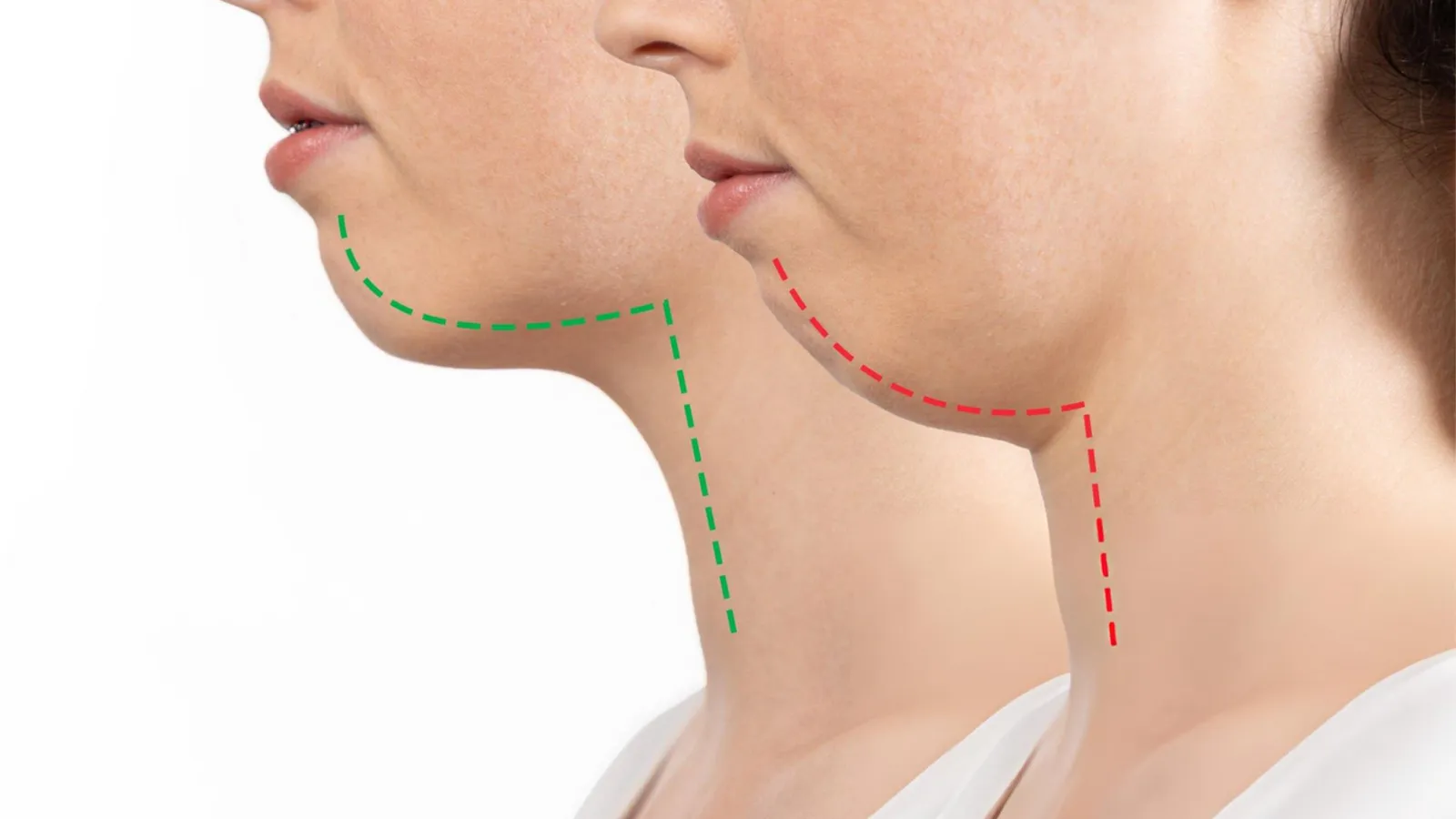 جنیوپلاستی قبل و بعد