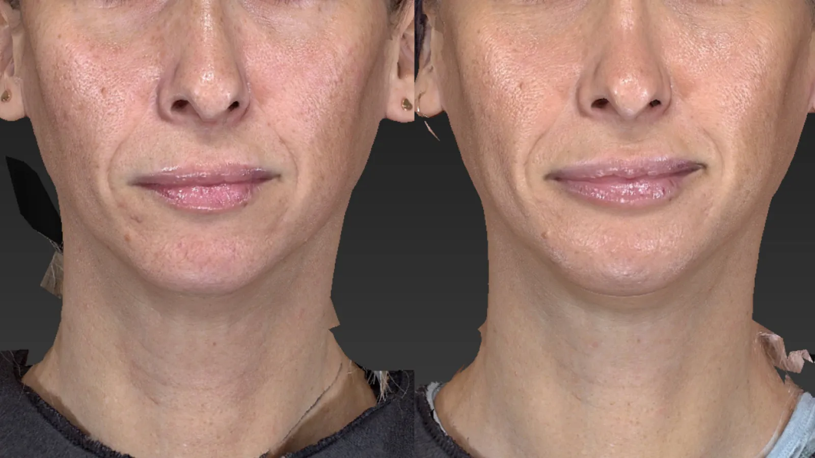 جنیوپلاستی چیه