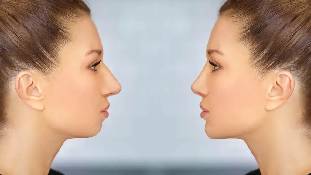 جراحي ژنيوپلاستي