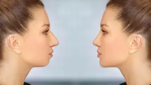 جراحي ژنيوپلاستي