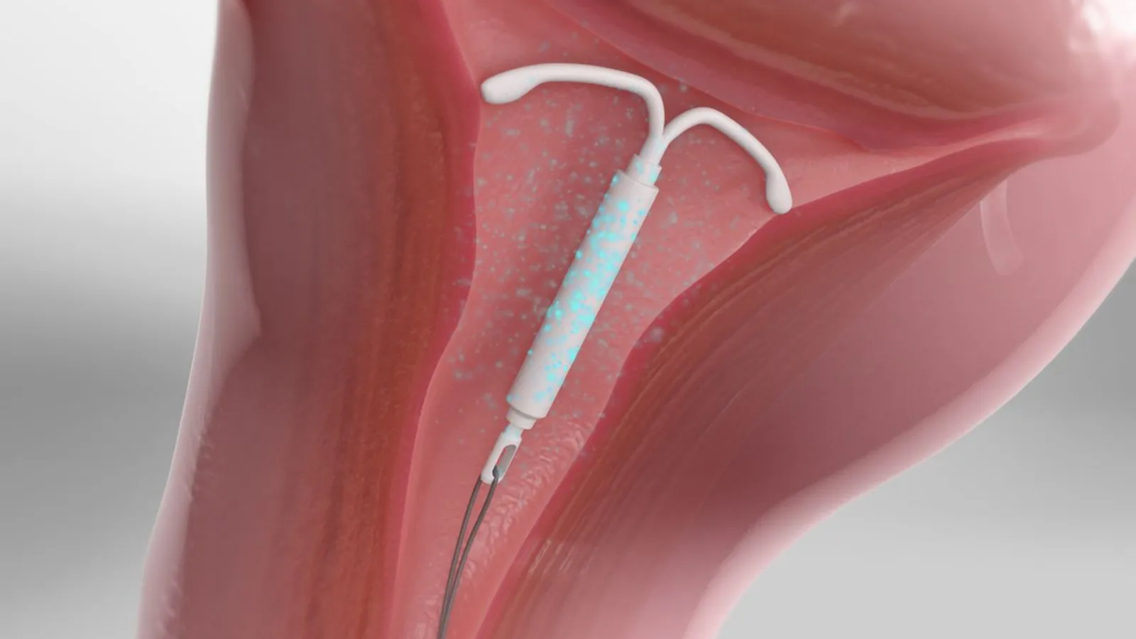 با آیودی باردار شدم