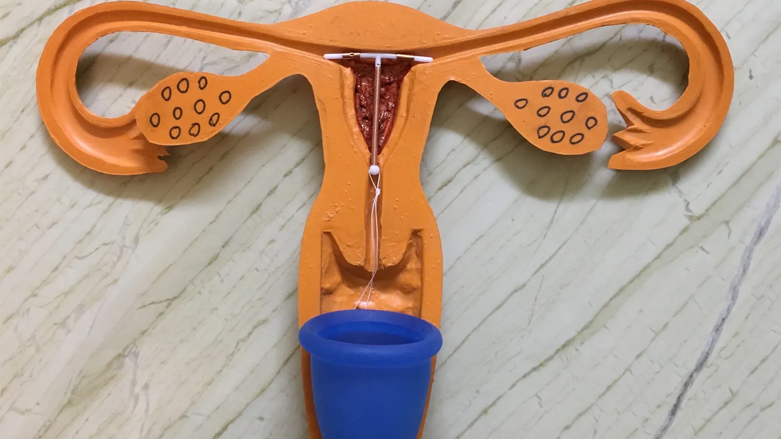 خونریزی بعد از درآوردن آیودی