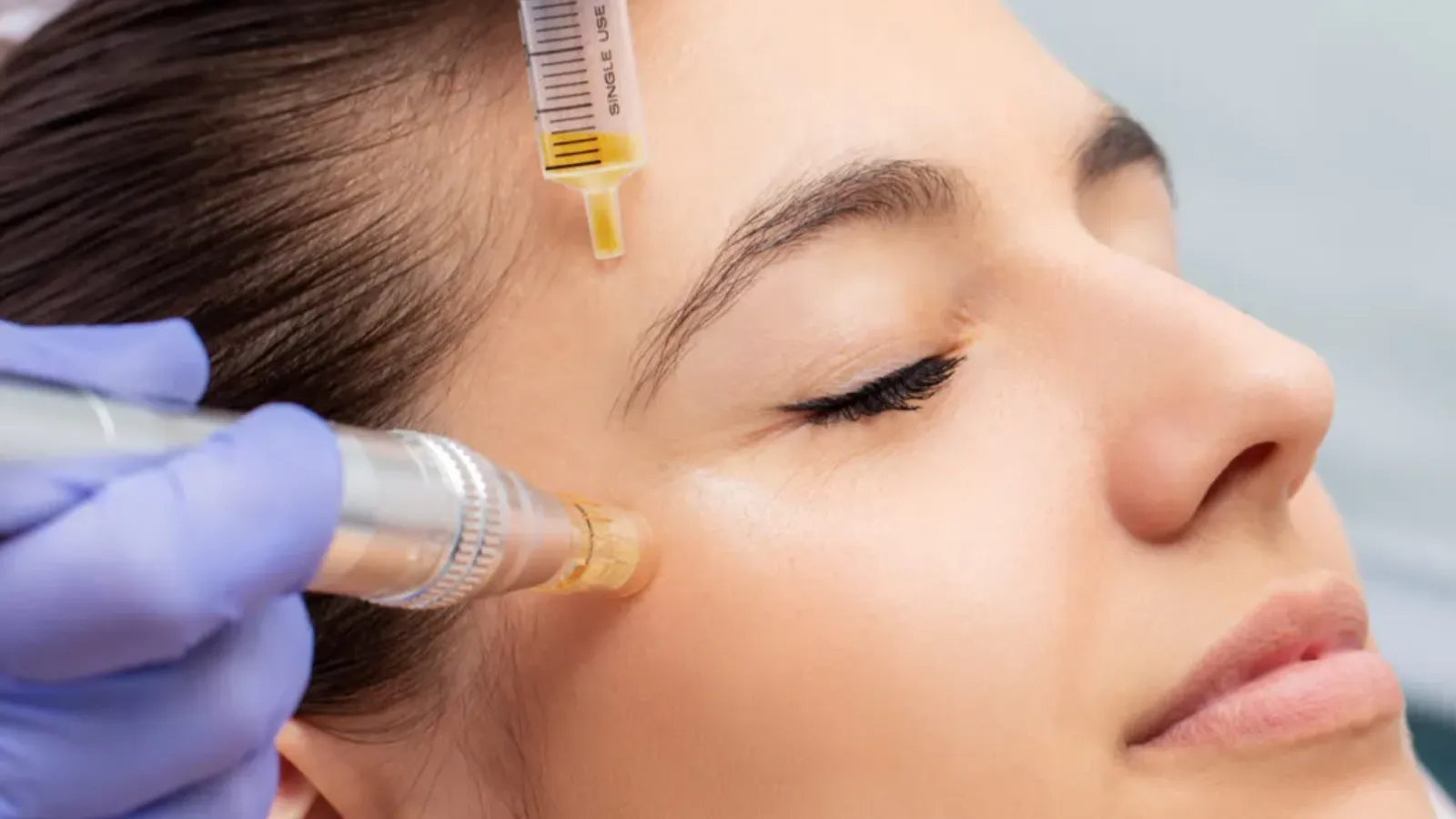 ماندگاری پی آر پی زیر چشم در ۶ ماه اول