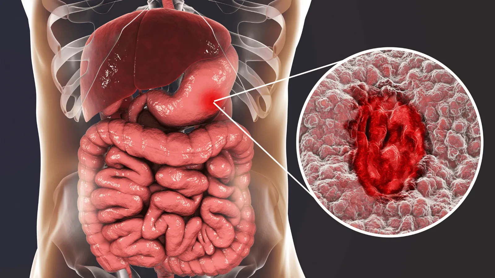 زخم معده عمل دارد
